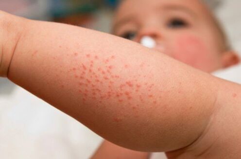 Allergie chez un enfant comme symptôme de la présence de vers